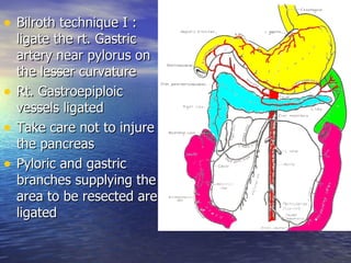 • Bilroth technique I :
    ligate the rt. Gastric
    artery near pylorus on
    the lesser curvature
•   Rt. Gastroepiploic
    vessels ligated
•   Take care not to injure
    the pancreas
•   Pyloric and gastric
    branches supplying the
    area to be resected are
    ligated
 