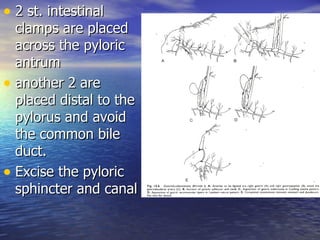 • 2 st. intestinal
  clamps are placed
  across the pyloric
  antrum
• another 2 are
  placed distal to the
  pylorus and avoid
  the common bile
  duct.
• Excise the pyloric
  sphincter and canal
 