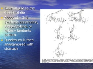• Equal in size to the
    duodenal dia
•   Apposed – 3-0 –
    synthetic absorbable,
    polypropylene, or
    nylon – lamberts
    pattern
•   Duodenum is then
    anastamosed with
    stomach
 