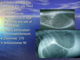 • A tissue density line
    dividing the gas filled
    stomach into
    compartments
•   VD - pylorus is near
    or near to the left of
    the midline
•   Gastric perforation-
    pneumoperitoneum
•   Clockwise 270
•   Anticlockwise 90
 