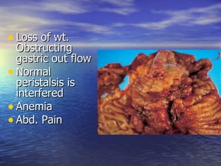 • Loss of wt.
  Obstructing
  gastric out flow
• Normal
  peristalsis is
  interfered
• Anemia
• Abd. Pain
 