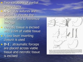 • Two variations of partial
    gastrectomy
•   A-C : stay sutures are
    placed to elevate the
    stomach and to minimize
    leakage
•   Necrotic tissue is excised
    with a rim of viable tissue
•   A two layer inverting
    closure is used
•   D-I : atraumatic forceps
    are placed across viable
    tissue and necrotic tissue
    is excised
 