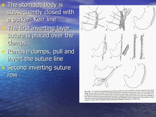 • The stomach body is
    subsequently closed with
    a parker- Kerr line
•   The first inverting layer
    suture is placed over the
    clamps
•   Remove clamps, pull and
    invert the suture line
•   Second inverting suture
    row
 