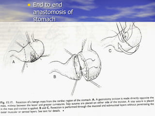 • End to end
 anastomosis of
 stomach
 