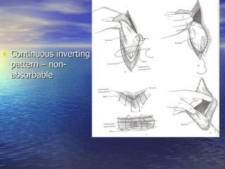• Continuous inverting
  pattern – non-
  absorbable
 