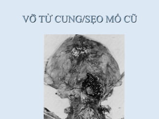 VỠ TỬ CUNG/SẸO MỔ CŨ
 