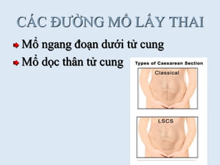 CÁC ĐƢỜNG MỔ LẤY THAI
Mổ ngang đoạn dƣới tử cung
Mổ dọc thân tử cung
 