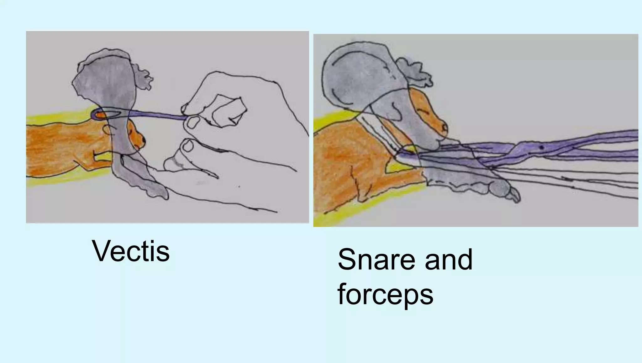 Vectis Snare and
forceps
 