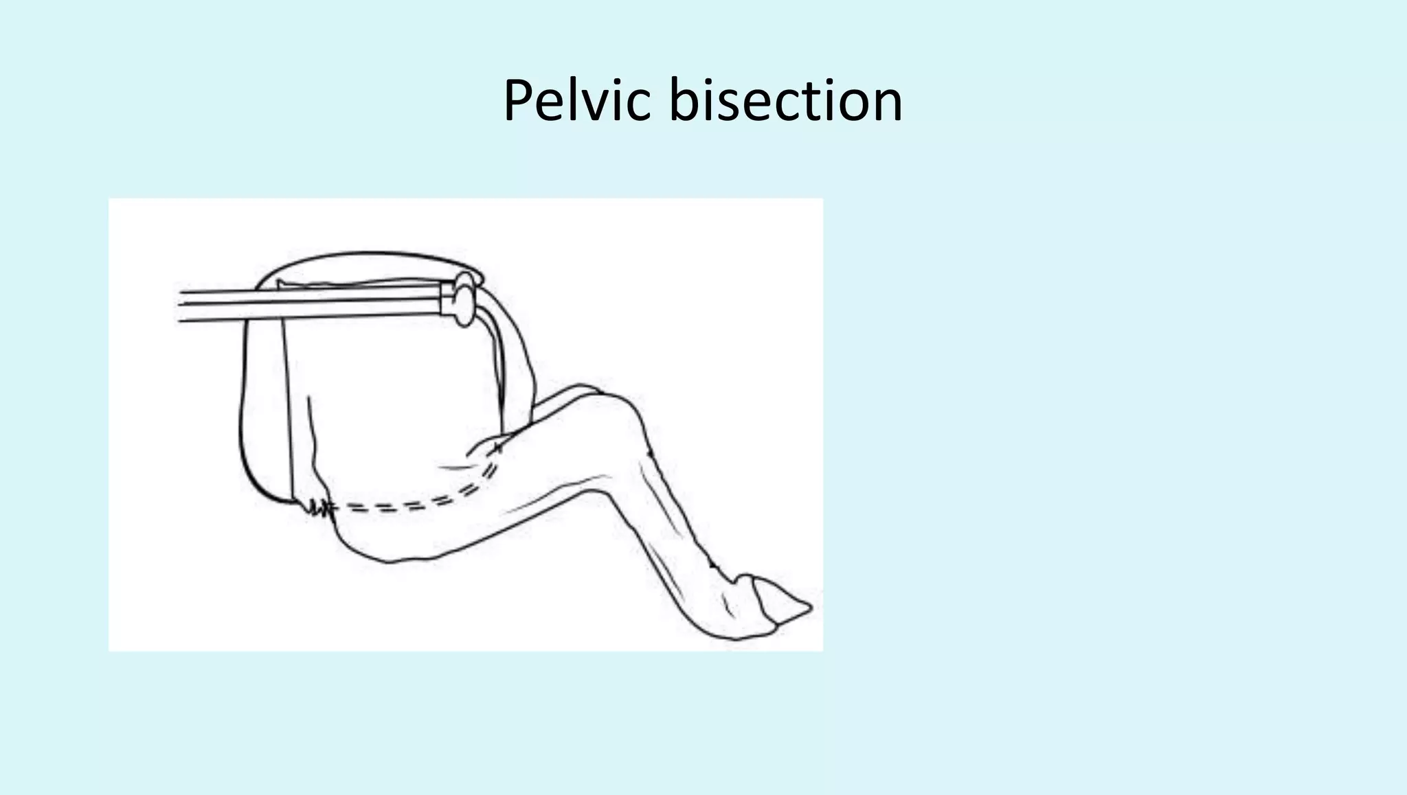Pelvic bisection
 