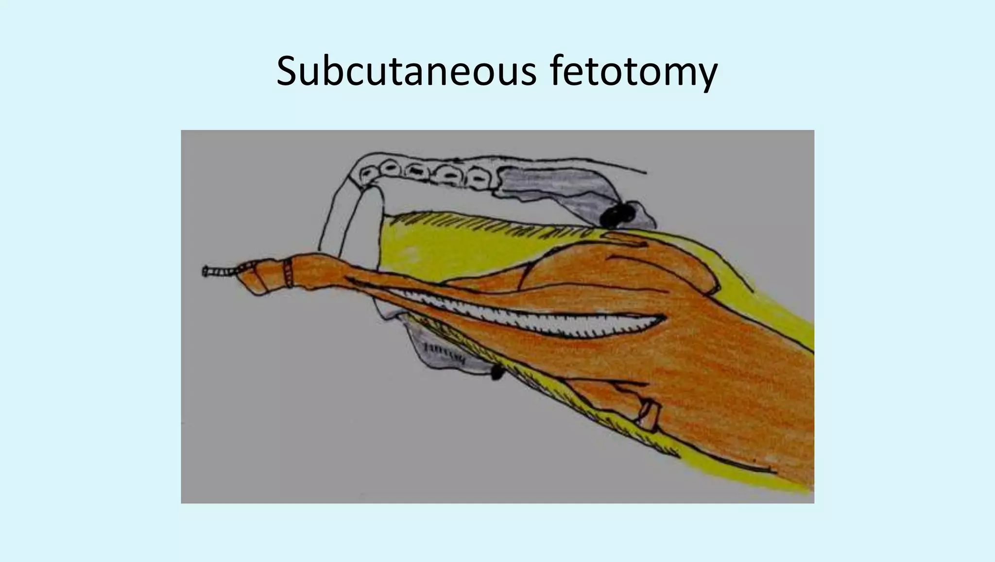 Subcutaneous fetotomy
 