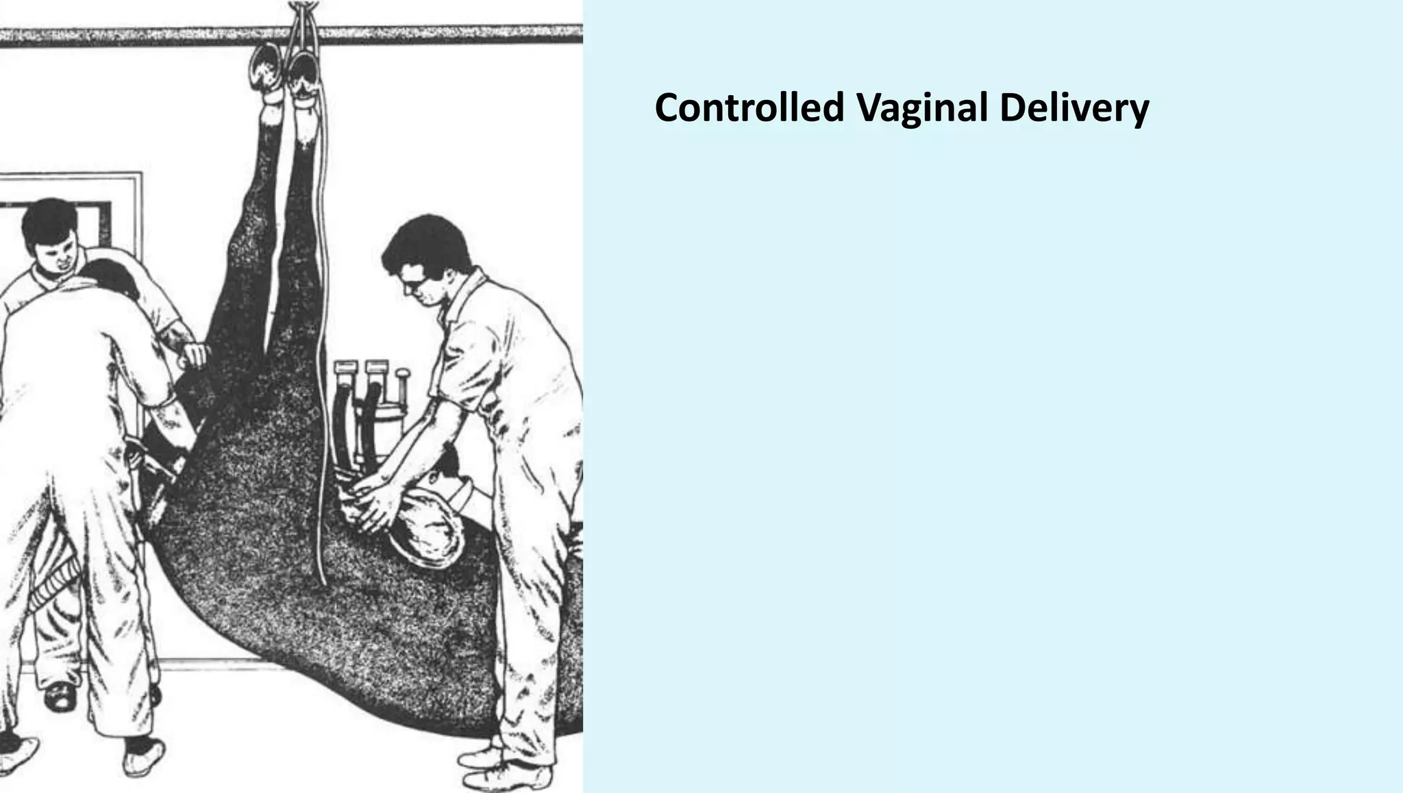 Controlled Vaginal Delivery
 