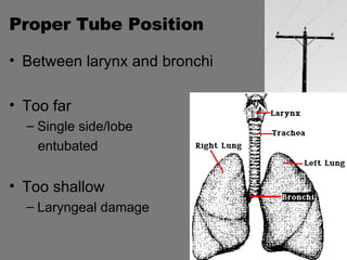 Proper Tube Position Between larynx and bronchi Too far Single side/lobe  entubated Too shallow Laryngeal damage 