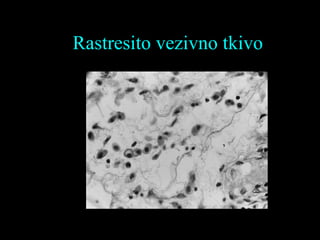 Rastresito vezivno tkivo
 