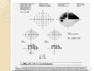 Visual field print out interpretation and analysis | PPTX
