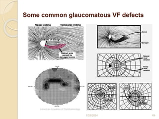 Visual field print out interpretation and analysis | PPTX