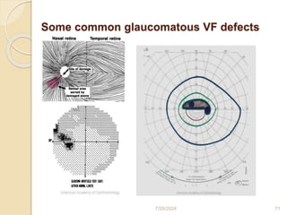 Visual field print out interpretation and analysis | PPTX
