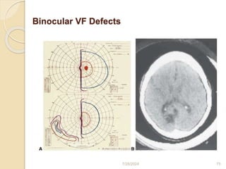 Visual field print out interpretation and analysis | PPTX