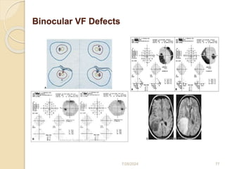 Visual field print out interpretation and analysis | PPTX