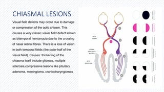 VISUAL FIELD EXAMINATION.VISUAL FIELD DEFECT PITUITARY AND CHIASMAL ...