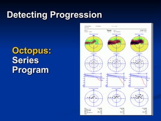 Octopus:
Series
Program
Detecting Progression
 