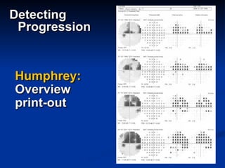 Humphrey:
Overview
print-out
Detecting
Progression
 