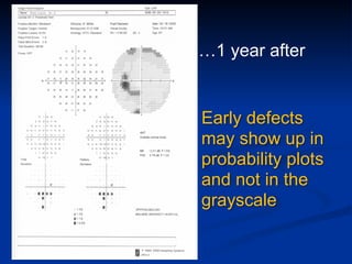 …1 year after
Early defects
may show up in
probability plots
and not in the
grayscale
 