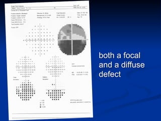 both a focal
and a diffuse
defect
 