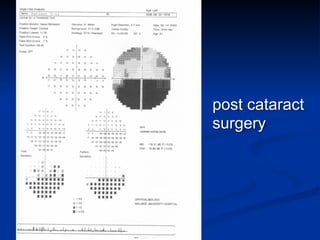 post cataract
surgery
 