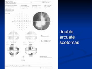 double
arcuate
scotomas
 
