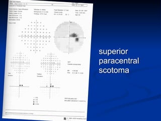 superior
paracentral
scotoma
 