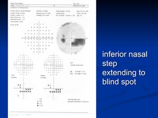 inferior nasal
step
extending to
blind spot
 