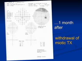 …1 month
after
withdrawal of
miotic TX
 