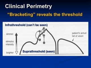 Clinical Perimetry
“Bracketing” reveals the threshold
Infrathreshold (can’t be seen)
Suprathreshold (seen)
 