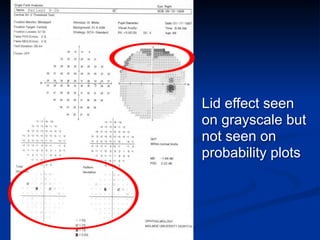 Lid effect seen
on grayscale but
not seen on
probability plots
 