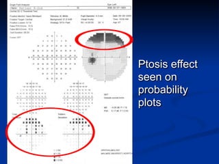 Ptosis effect
seen on
probability
plots
 