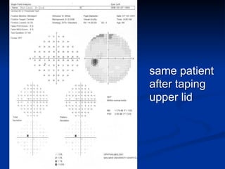 same patient
after taping
upper lid
 