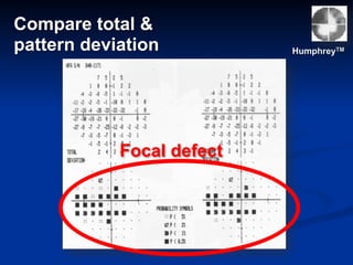 Focal defect
Compare total &
pattern deviation HumphreyTM
 