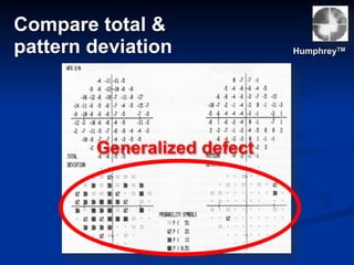 HumphreyTM
Generalized defect
Compare total &
pattern deviation
 