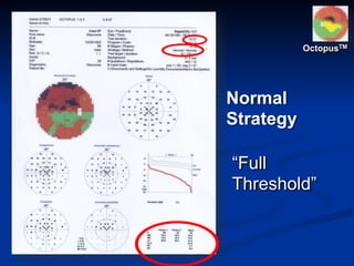 “Full
Threshold”
Normal
Strategy
OctopusTM
 