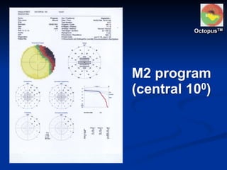 M2 program
(central 100)
OctopusTM
 
