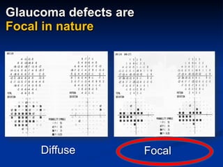 Glaucoma defects are
Focal in nature
Diffuse Focal
 