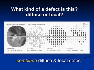 What kind of a defect is this? 
diffuse or focal?
combined diffuse & focal defect
 