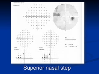 Superior nasal step
 