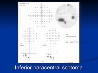 Inferior paracentral scotoma
 