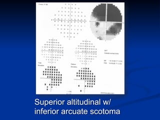 Superior altitudinal w/
inferior arcuate scotoma
 