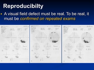 Reproducibilty
■ A visual field defect must be real. To be real, it
must be confirmed on repeated exams
 