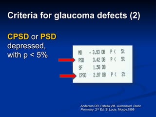 Criteria for glaucoma defects (2)
CPSD or PSD
depressed,  
with p < 5%
Anderson DR, Patella VM. Automated Static
Perimetry. 2nd Ed. St Louis: Mosby,1999
 