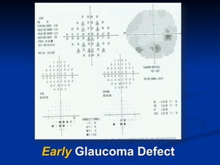 Early Glaucoma Defect
 