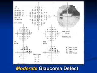 Moderate Glaucoma Defect
 