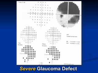 Severe Glaucoma Defect
 